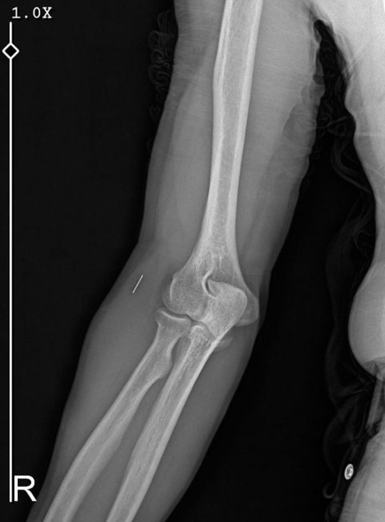 Bayramda kabusu yaşadı: Parmağı alındı, işinden oldu | Elinden koluna doğru ilerlemiş