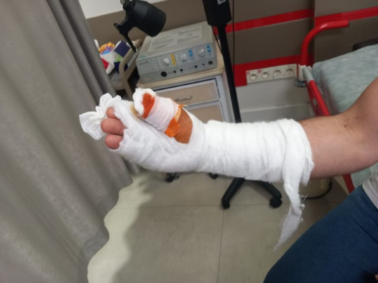 Bayramda kabusu yaşadı: Parmağı alındı, işinden oldu | Elinden koluna doğru ilerlemiş