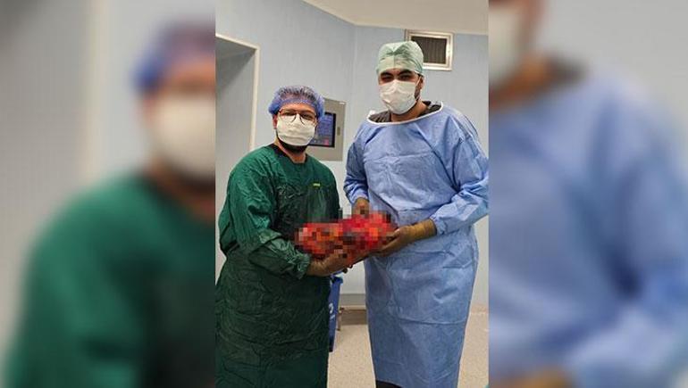 Yıllardır bir bebek gibi karnında taşıyordu Gaziantep’te 30 dakikada 8 kiloluk böbrek operasyonu